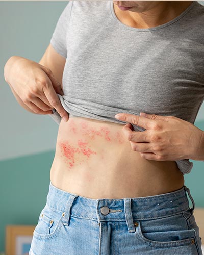 Skin Rashes Treatment in McDonough, GA