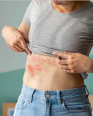 Skin Rashes Treatment in McDonough, GA