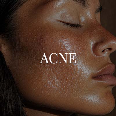 Acne in McDonough, GA