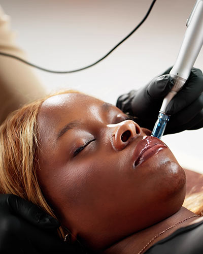 Microneedling in McDonough, GA