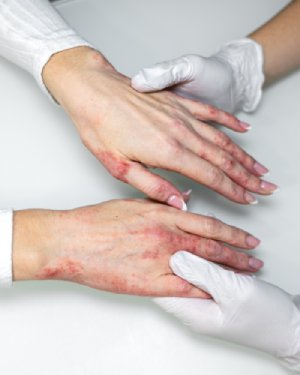 Psoriasis Treatment in McDonough, GA